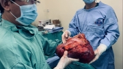 Bệnh viện K phẫu thuật thành công loại bỏ u sau phúc mạc kích thước khủng 40cm