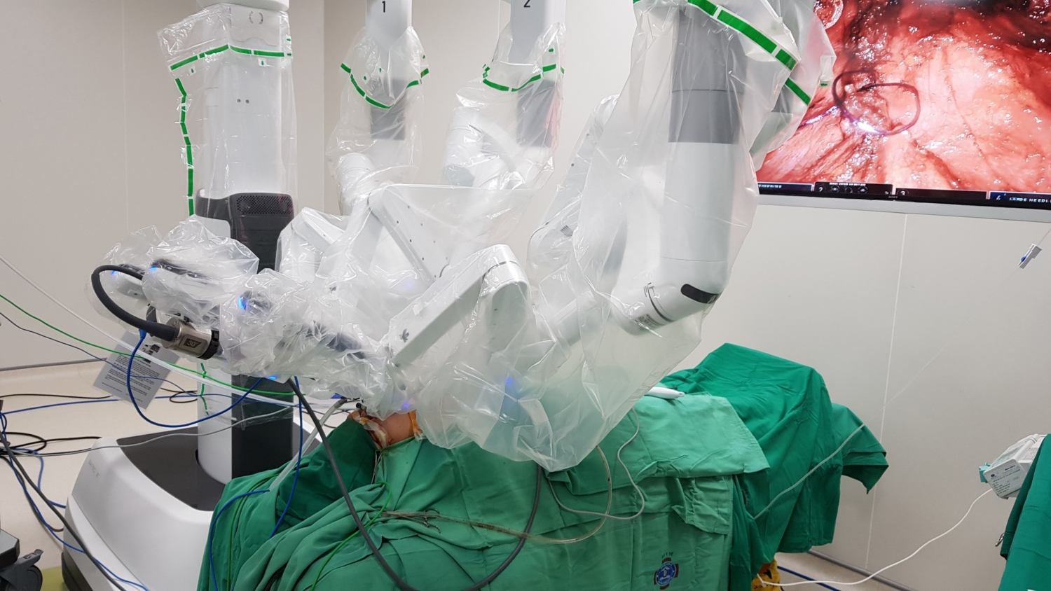 Bệnh viện K phẫu thuật thành công u tuyến giáp bằng hệ thống Robot lần đầu tiên tại Việt Nam